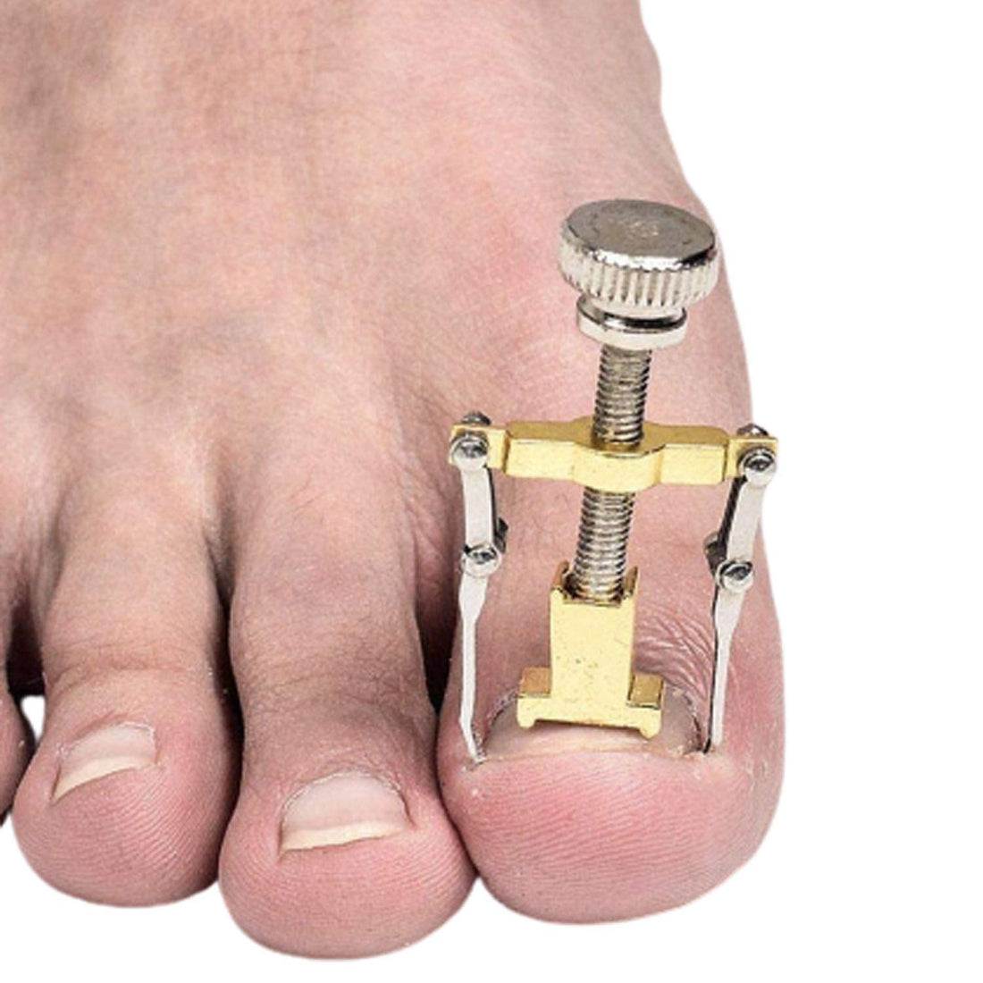 Glamza Ingrown Toenail Tool Corrector Clamp for Safe & Effective Treatment of Ingrown Toenail