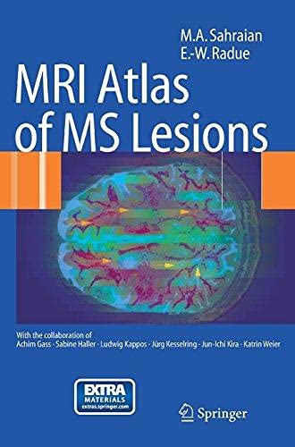 MRI Atlas of MS Lesions