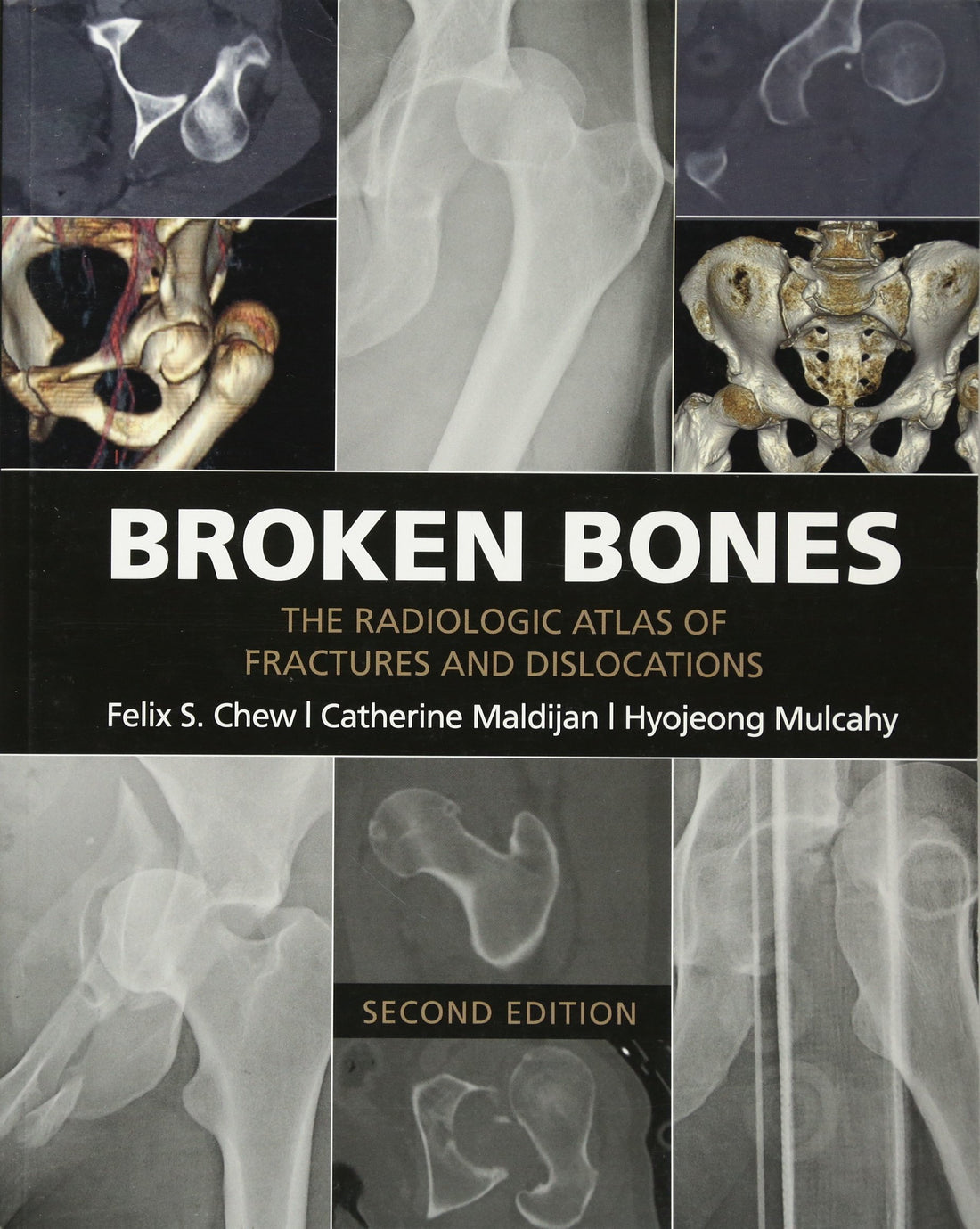Cambridge University Press Broken Bones: The Radiologic Atlas of Fractures and Dislocations
